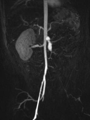 Frontiers | Interferonopathies masquerading as non-Mendelian